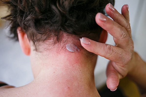 Eczema 50 1. Chống nấm da đầu