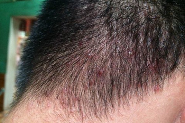 Da đầu ngứa và mọc mụn là dấu hiệu của bệnh gì? 1