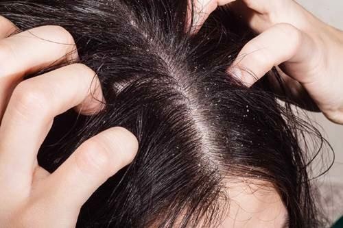 1. Ngứa da đầu và rụng tóc nhiều là bệnh gì? 1