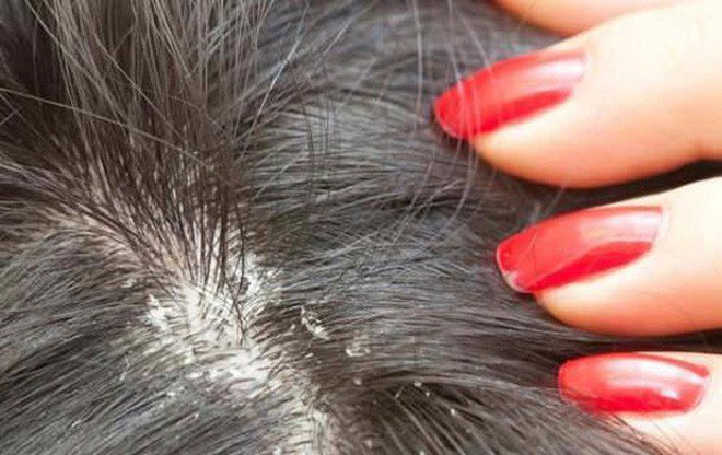 Các tình trạng da đầu thường gặp: Cách nhận biết và điều trị