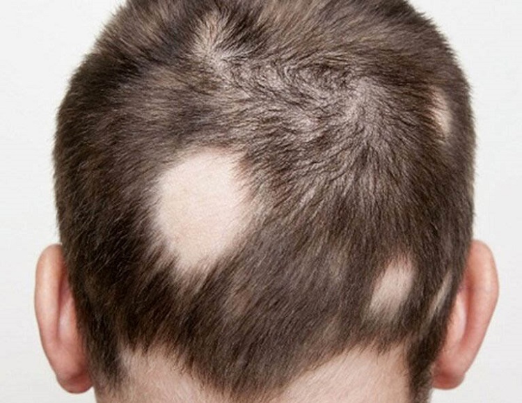 2. Nguyên nhân nào khiến tóc rụng từng mảng? 1