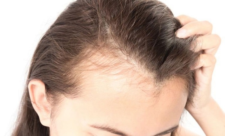 Rụng tóc, tạo thành dáng tóc chữ M có thể là do bệnh lý 