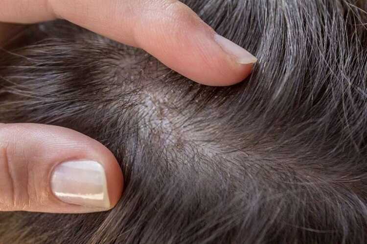 Tóc rụng có hạt trắng như nhân mụn ở chân có nguy hiểm không? 1