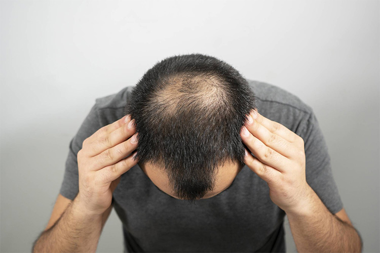 Các loại hói đầu ở nam giới - nguyên nhân và cách chữa 1