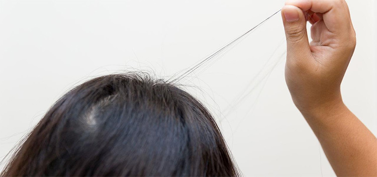 Căng thẳng dẫn đến rụng tóc như thế nào? 3