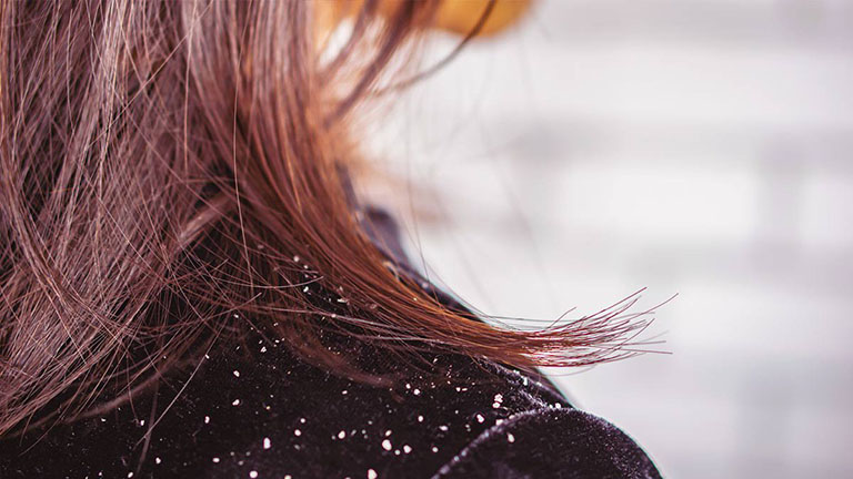 Tìm hiểu lý do tại sao gàu trên da đầu xuất hiện nhiều hơn vào mùa đông
