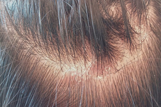 Top 10 loại dầu gội trị nấm da đầu được nhiều người tin dùng