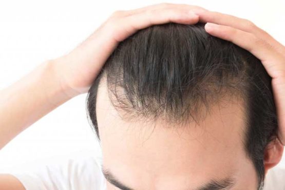 Cách chăm sóc tóc mỏng nam giới không nên bỏ qua