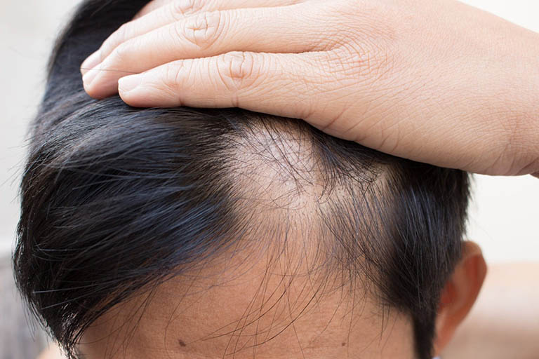 Hơn 100 ảnh về chữa rụng tóc ở nam giới  daotaoneceduvn