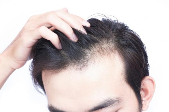 Nguyên nhân và cách khắc phục rụng tóc nhiều ở nam giới tuổi dậy thì