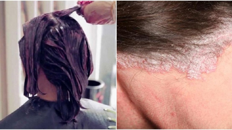 Nguyên nhân vì sao da đầu bị chảy nước vàng sau khi nhuộm tóc? 1