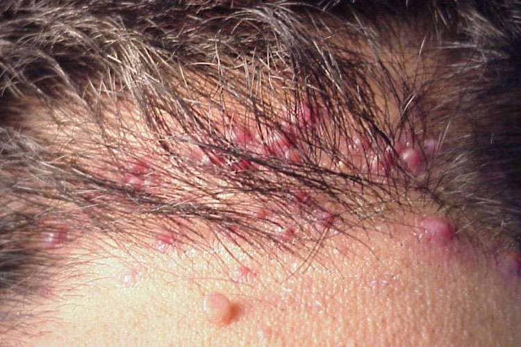 Nguyên nhân khiến da đầu bị tổn thương và cách điều trị 1