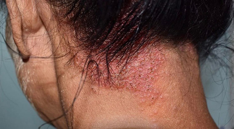 Viêm da cơ địa ở đầu (seborrheic dermatitis) 1